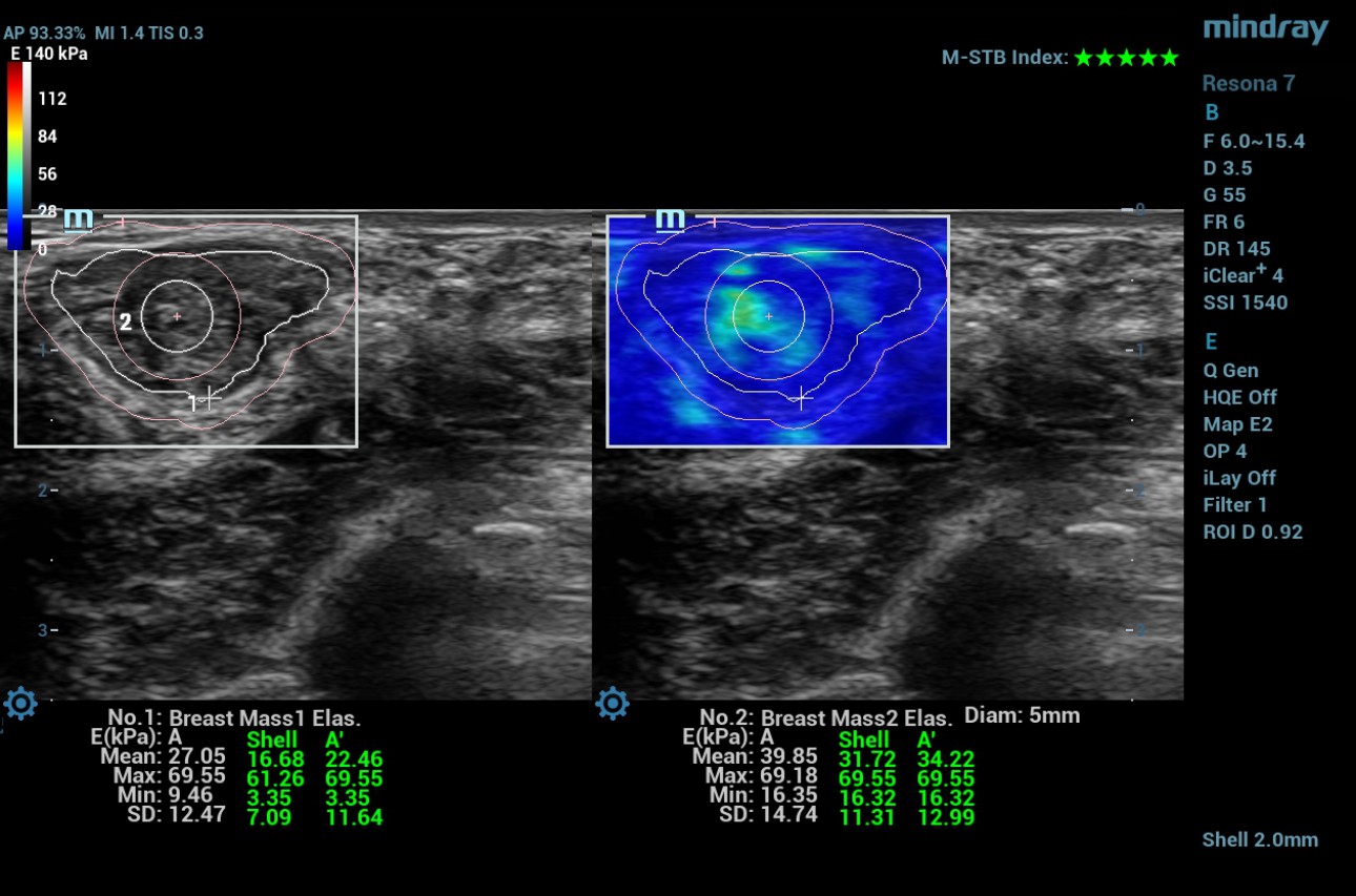swe-prior-breast-mass-fig3-pc