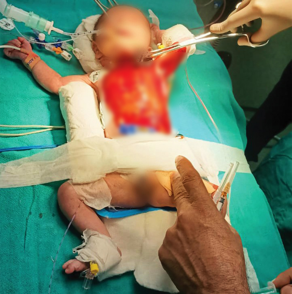 Post-op patient on operating table