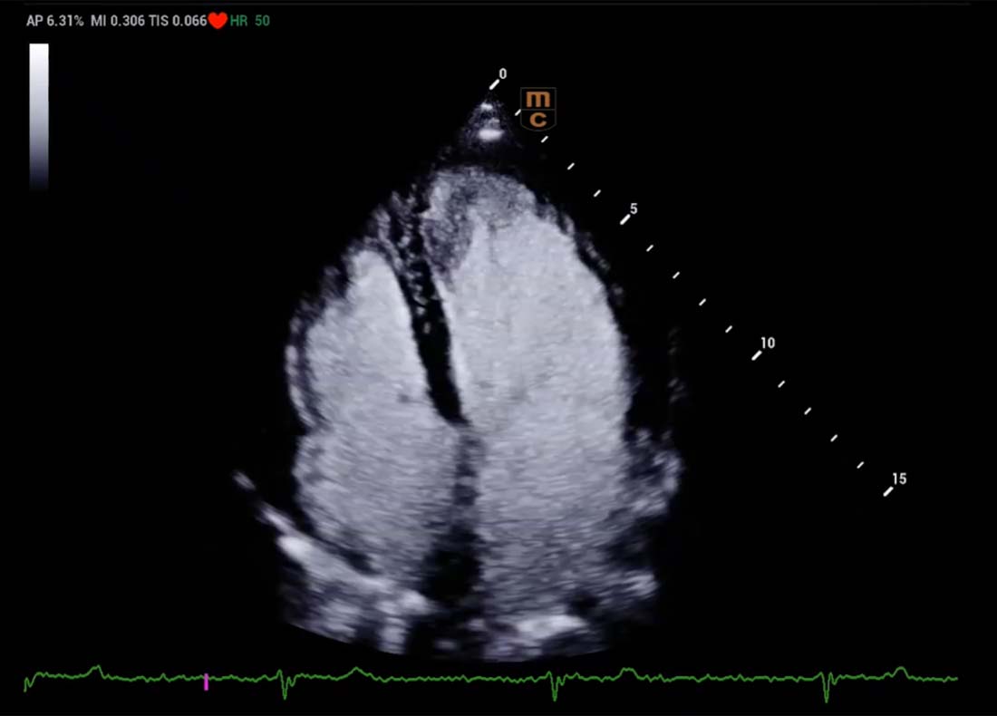 Recho R9 Contrast-enhanced Echocardiography - LVO image