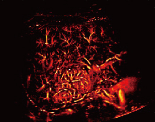 Iperplasia nodulare focale