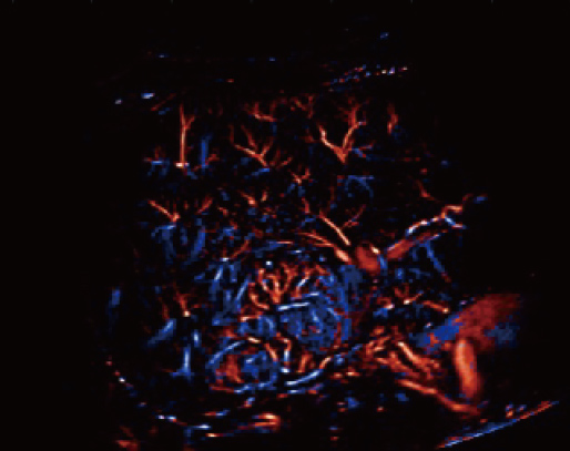 Iperplasia nodulare focale