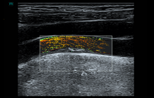 Ultrasound Journal 40 - Carotid Plaque: Conventional and Innovation Technique