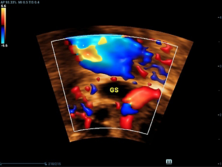 Ectopic Pregnancy: Diagnostic Role of Transvaginal Ultrasound