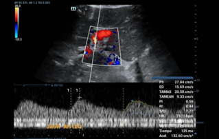 Ultrasound Journal 37 - Evaluation of liver graft by contrasted ultrasound and variables that may alter normality