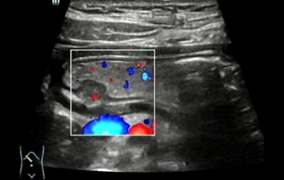 Ultrasound Journal 5 - Hidden World Under the Mucosa - ??? ??? ?? Gastric Wall? Ectopic Pancreas ??