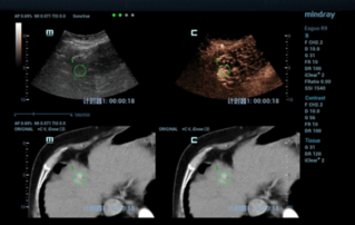 Ultrasound Journal 1: Mindray "Fusion imaging"? ??? ??? ?? Micowave Ablation ??? ?? 