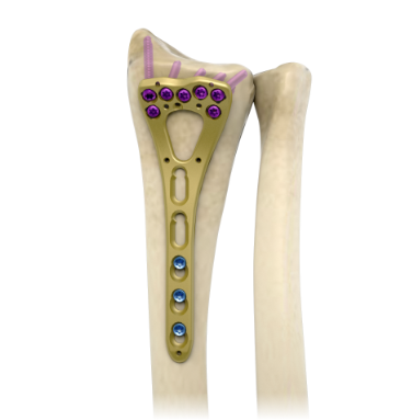 Блокируемая пластина