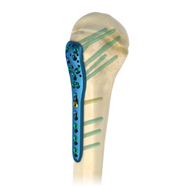 Винты для пластин